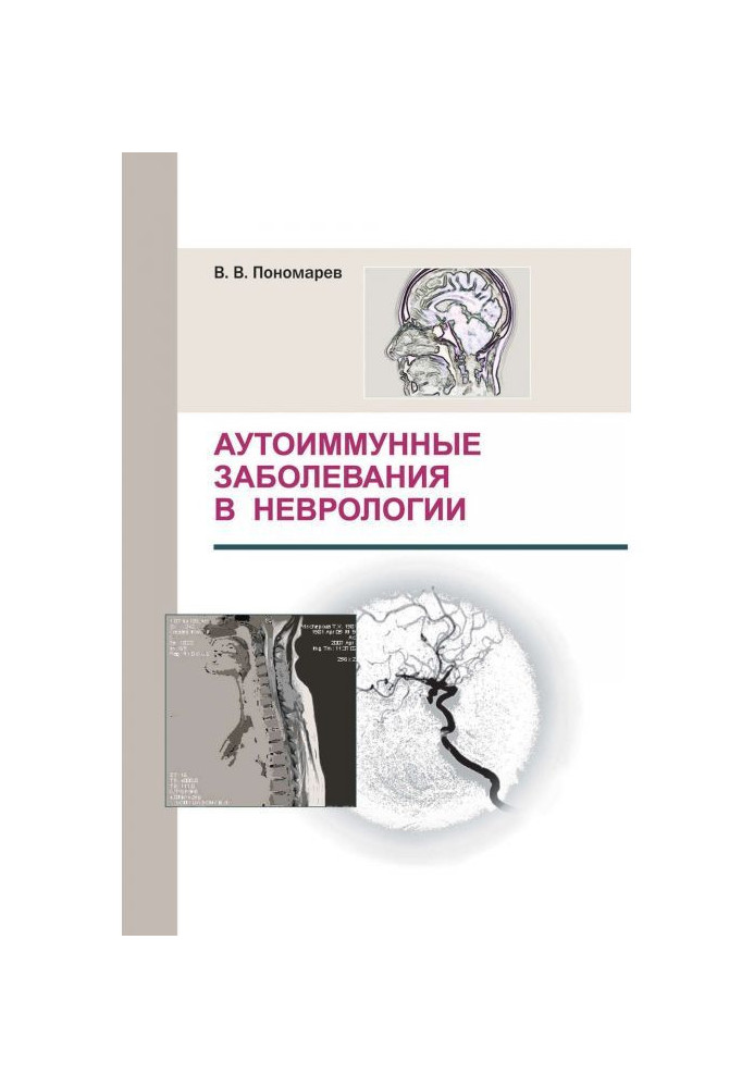 Аутоіммунні захворювання в неврології