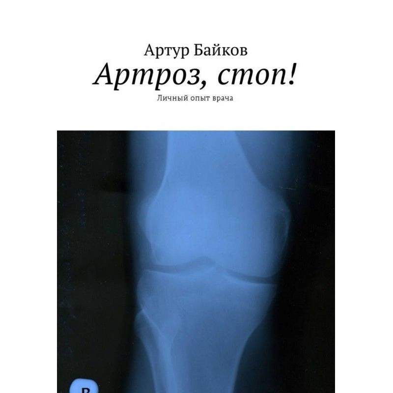 Arthrosis, feet! Personal...