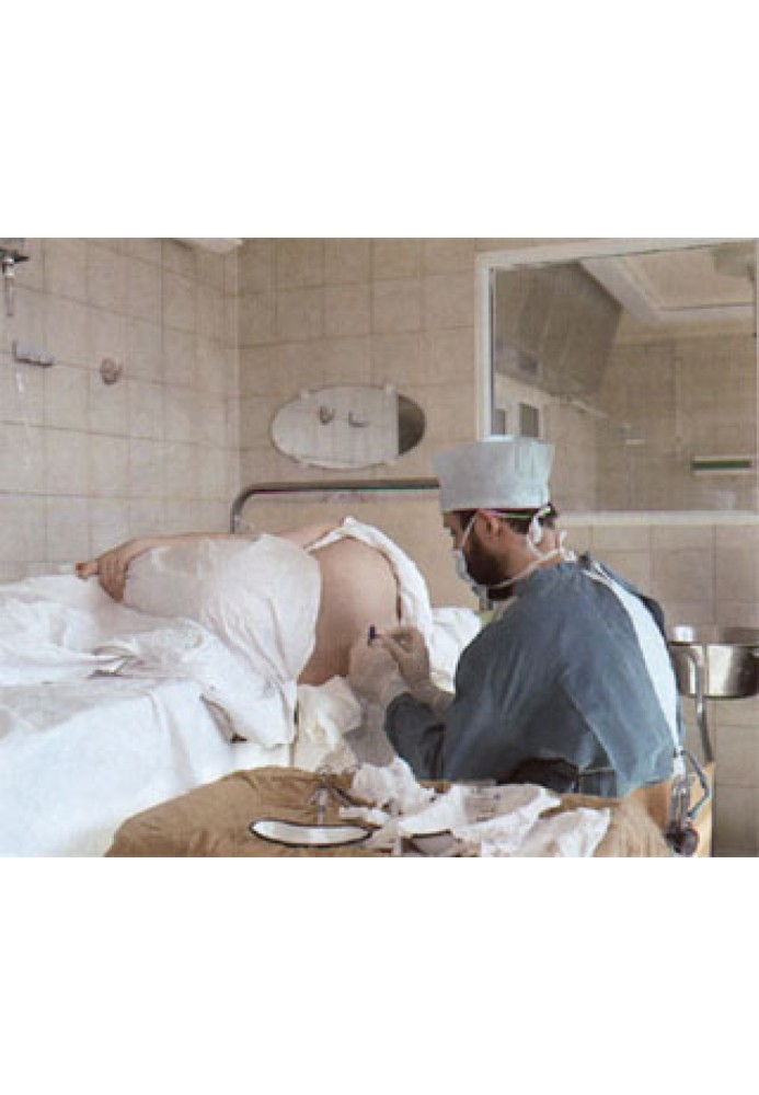 Childbirth and epidural anesthesia.