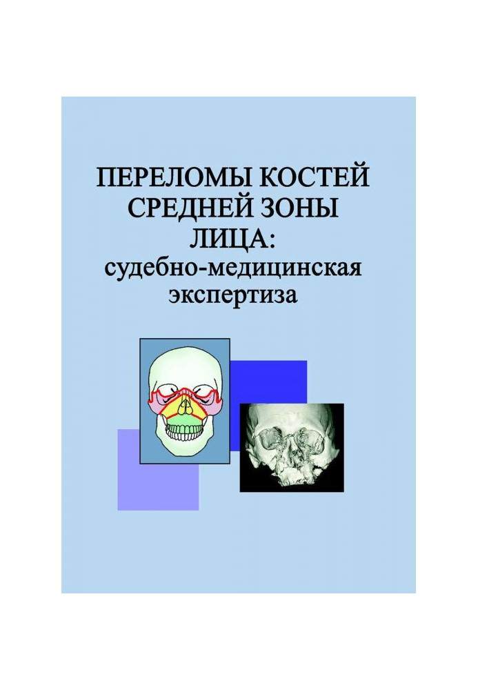 Переломи кісток середньої зони особи: судово-медична експертиза