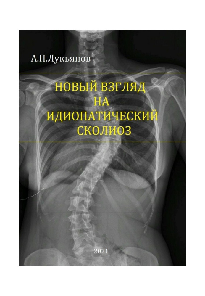 A new look at idiopathic scoliosis