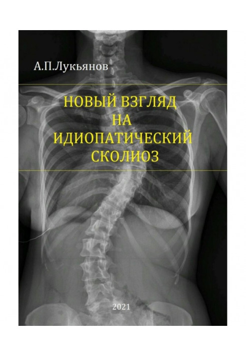 A new look at idiopathic scoliosis